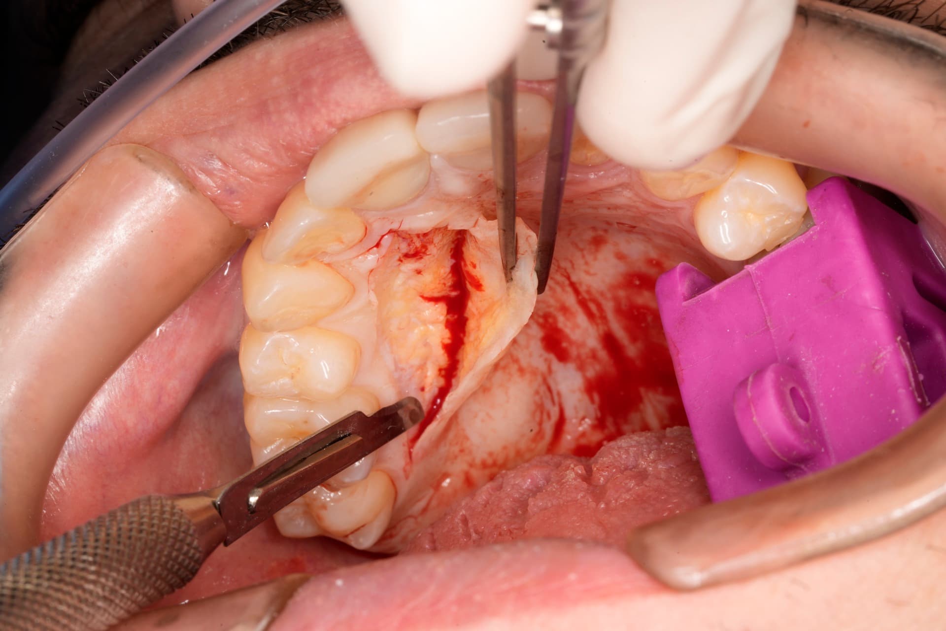 Colgajo de paladar en cirugía plástica periodontal — Dr. Pablo Urrutia, PerioPlastic