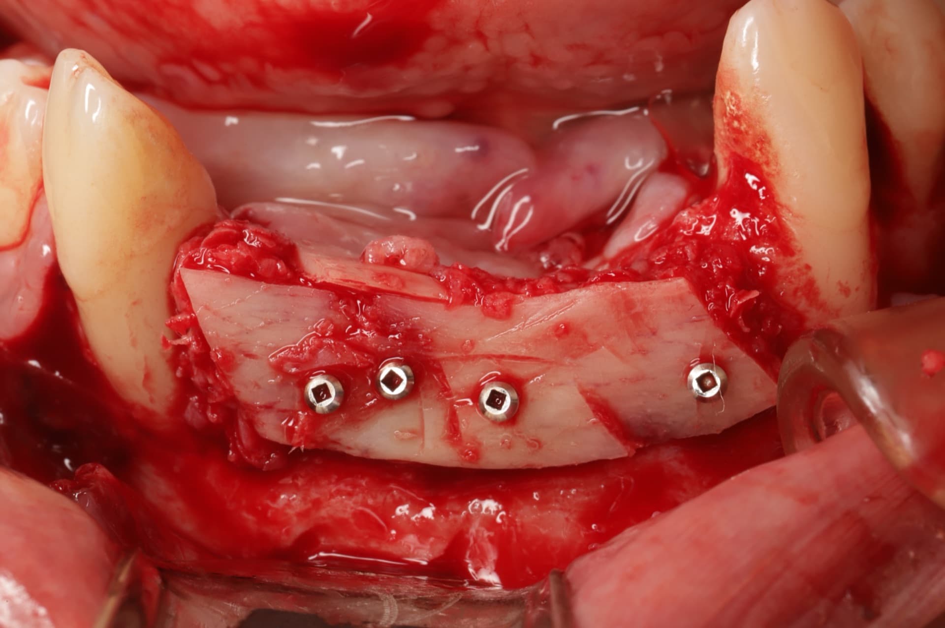 Técnica Khoury de regeneración ósea vertical — Dr. Pablo Urrutia, PerioPlastic