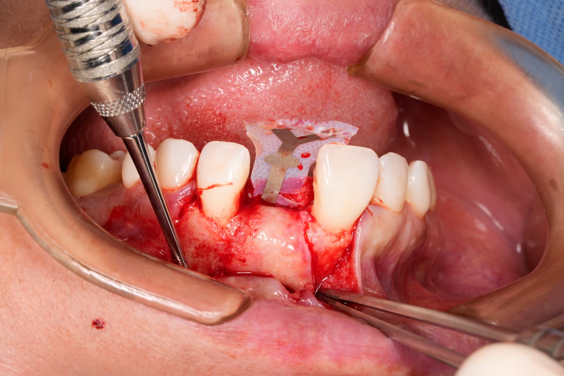 Membrana PTFE en ROG vertical — regeneración ósea guiada, PerioPlastic