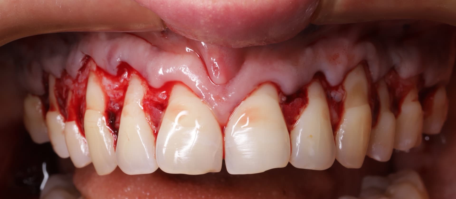 Cirugía plástica periodontal con técnica túnel — Dr. Pablo Urrutia, PerioPlastic