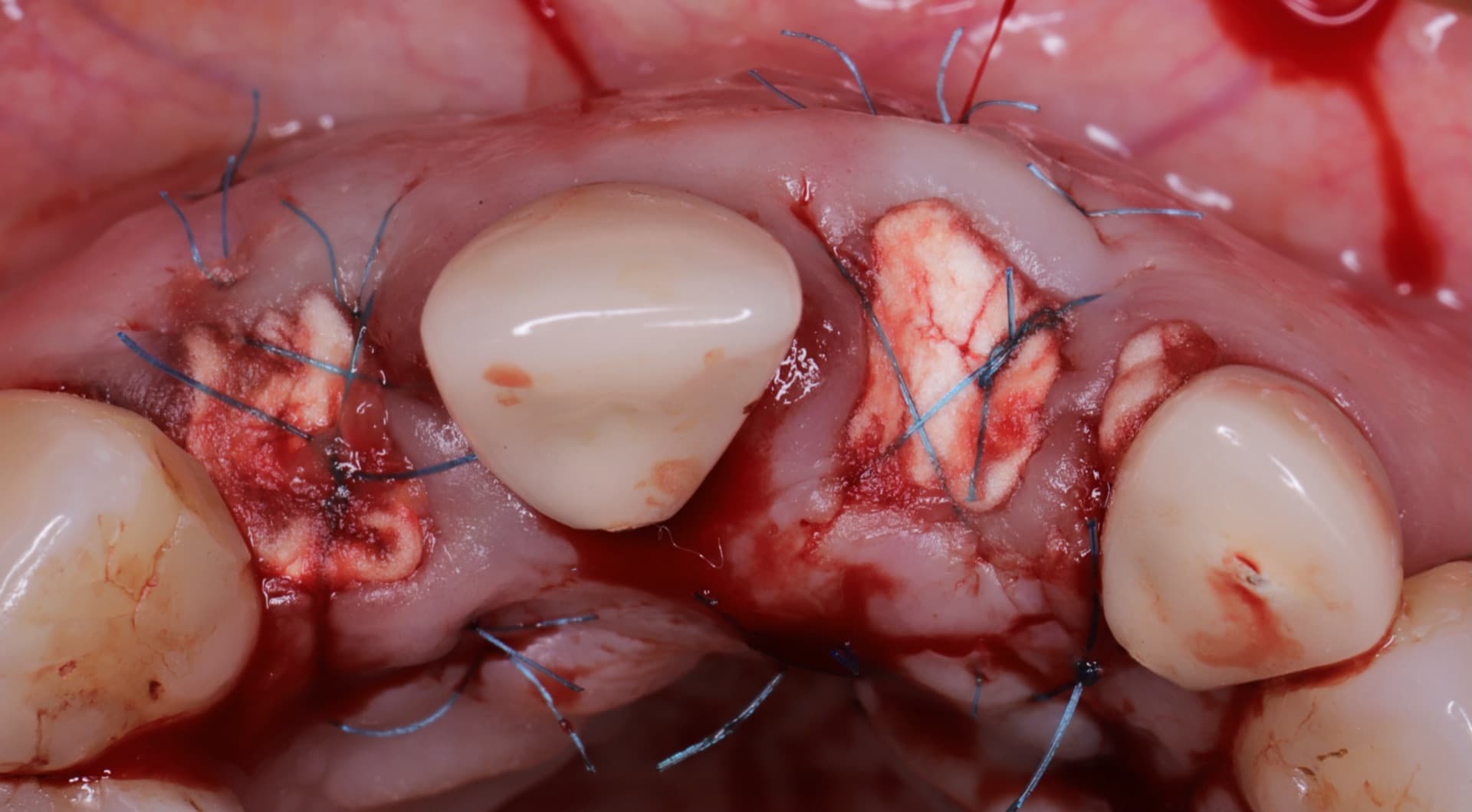 Preservación alveolar post-extracción para regeneración ósea — PerioPlastic