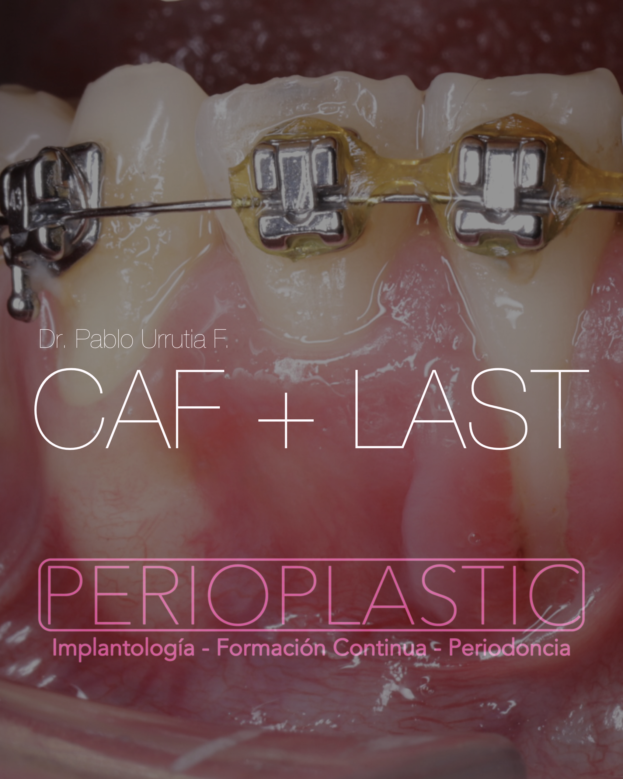 CAF + LAST — Recubrimiento radicular con cambio de biotipo