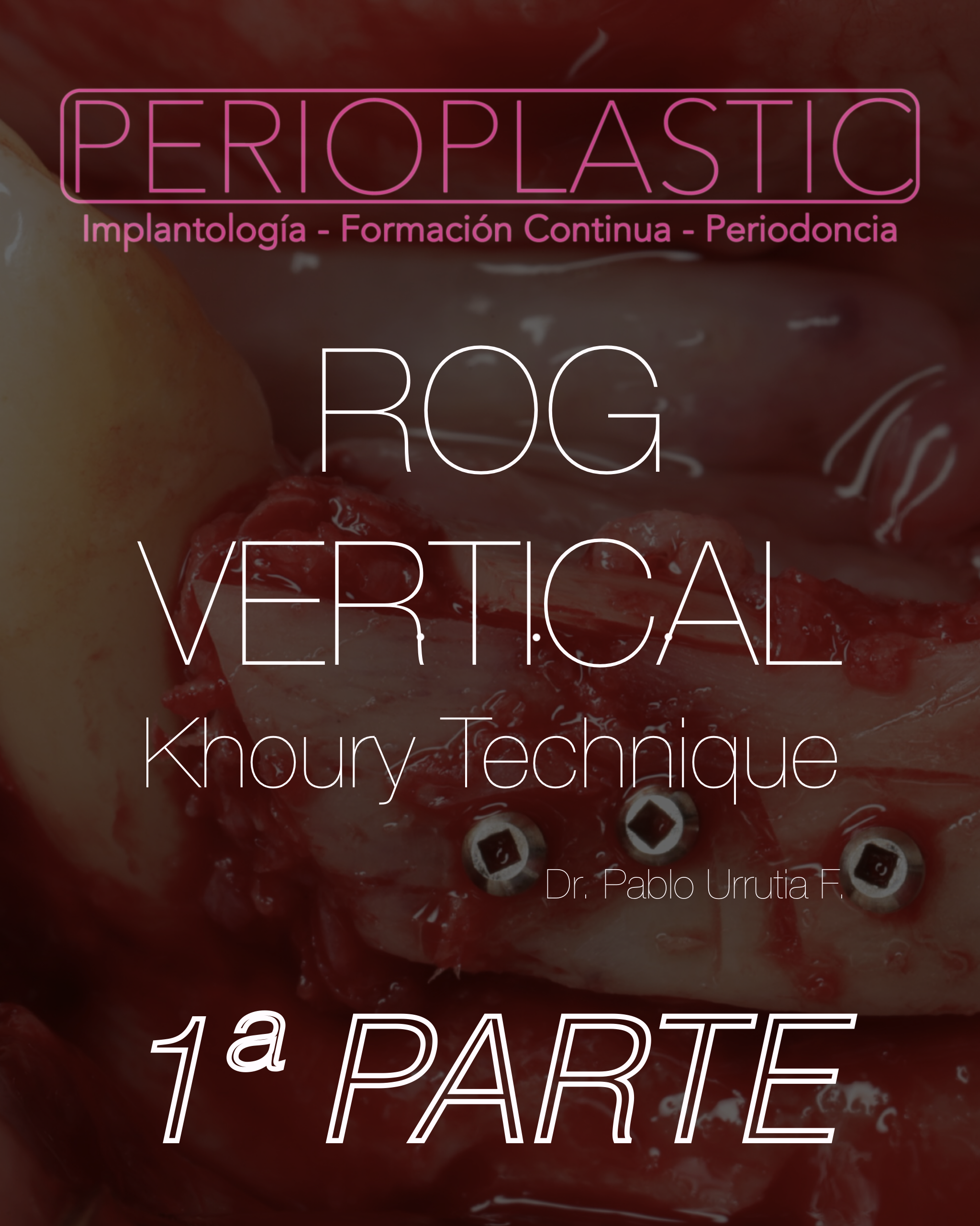 ROG Vertical — Técnica Khoury · 1ª Parte