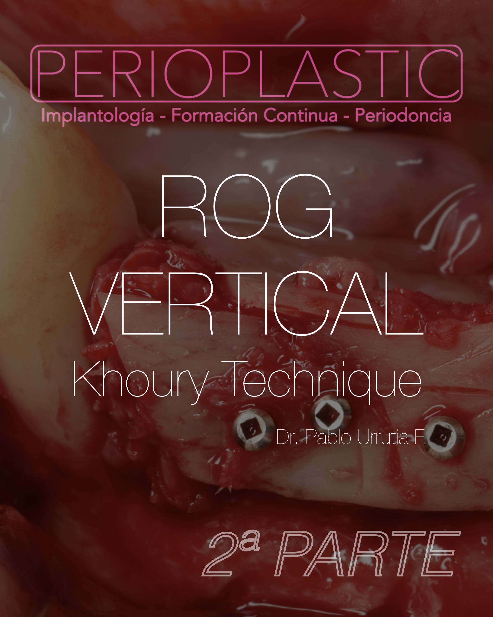 ROG Vertical — Técnica Khoury · 2ª Parte